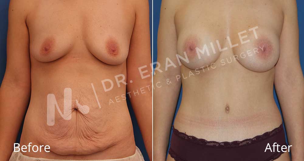 מתיחת בטן: ניתוח מתיחת בטן לפני ואחרי | ניתוח הגדלת חזה לפני ואחרי- דר ערן מילט